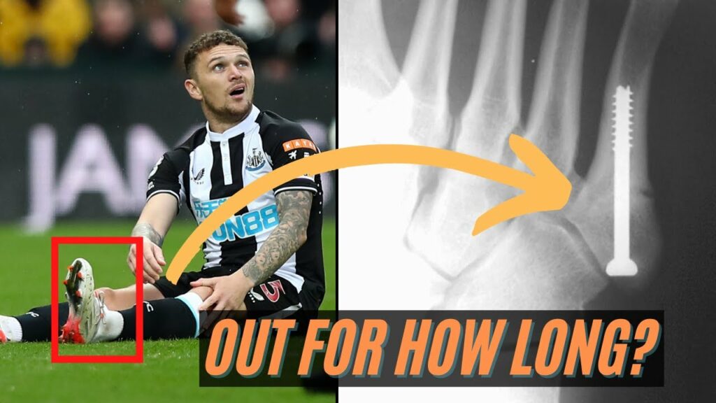 Expert Explains Kieran Trippier Injury (foot fx), Surgery & Timeline Expert Explains Kieran Trippier Injury (foot fx), Surgery & Timeline