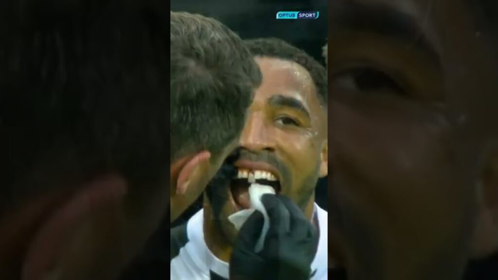 🙏🥺🤯Respect Callum Wilson😬🦷🙏#shorts#newcastle#premierleague #injury#football#footballshorts#respect