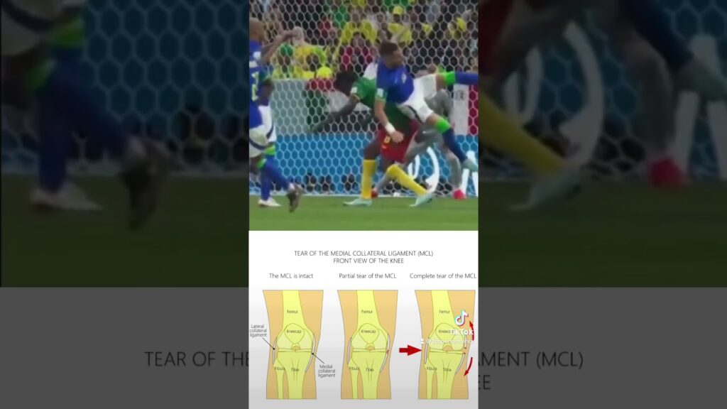 Alex Telles Knee Injury | #brasil #brazil #worldcup #worldcup2022 | #benfica #manchesterunited