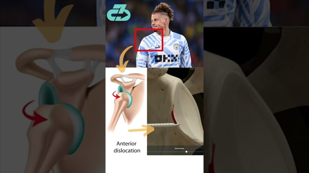 Expert Explains Kalvin Phillips Injury (Shoulder Instability) & Timeline #shorts