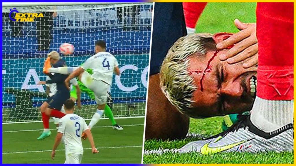 La réaction de Griezmann quand il se fait ouvrir le crâne La réaction de Griezmann quand il se fait ouvrir le crâne