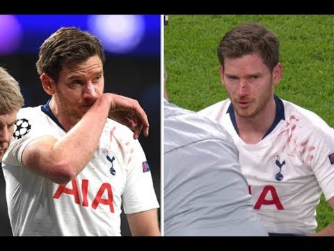 Vertonghen breaks his face ! Tottenham Ajax 0-1