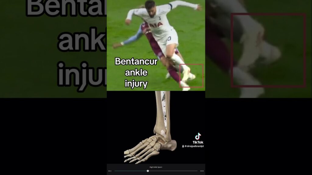 Rodrigo Bentancur ankle injury. Expert explains | #tottenham #thfc #premierleague #epl #football
