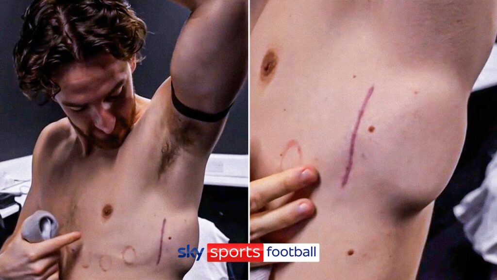 Tom Lockyer shows off ‘battle wound’ after having defibrillator fitted Tom Lockyer shows off 'battle wound' after having defibrillator fitted