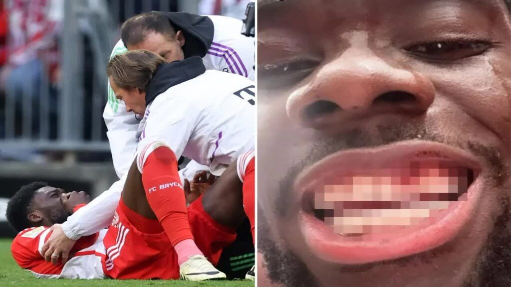 Bayern Munich star Davies' teeth knocked out of place after horror challenge