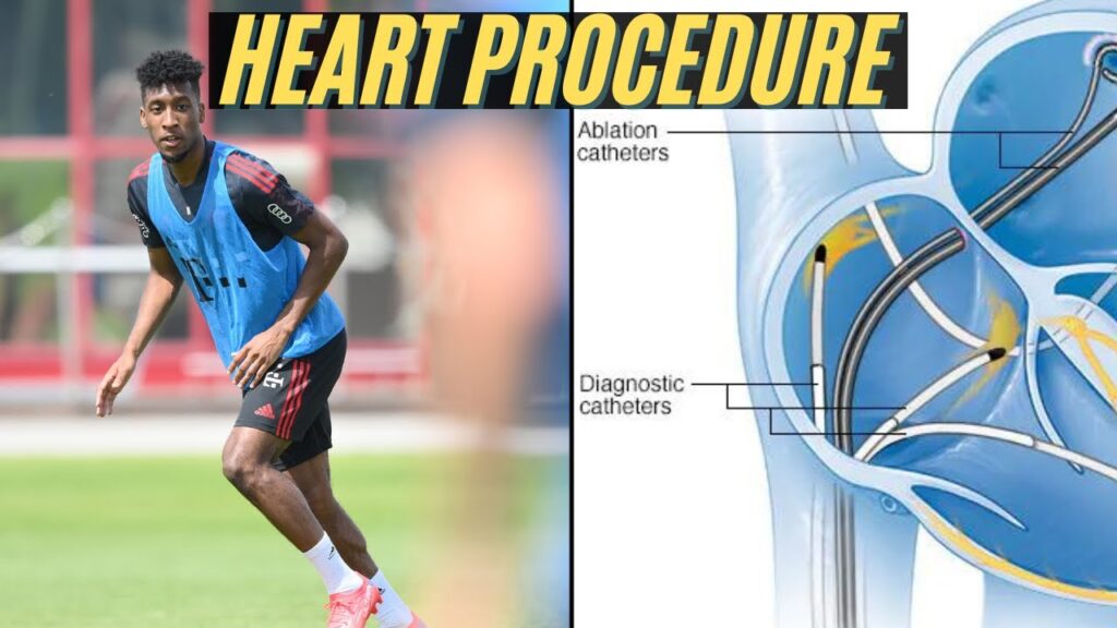 Expert Explains Kingsley Coman Heart Procedure | How Risky Is It?