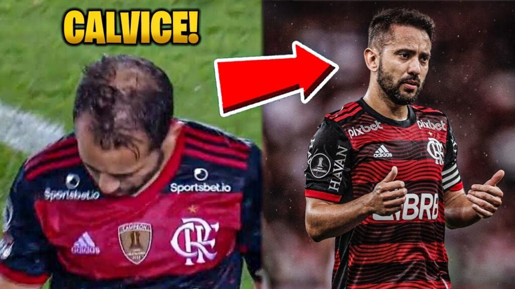 EVOLUÇÃO DA CALVICE DE ÉVERTON RIBEIRO – ANTES & DEPOIS DO TRATAMENTO!😱 EVOLUÇÃO DA CALVICE DE ÉVERTON RIBEIRO - ANTES & DEPOIS DO TRATAMENTO!😱