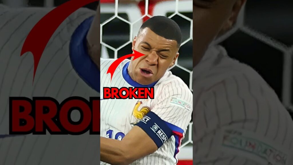 MBAPPE BROKE HIS NOSE🤕 #mbappe #football #euro