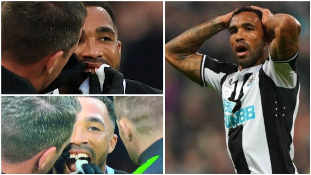 Callum Wilson’s tooth falls out after whack in face during Newcastle vs Arsenal