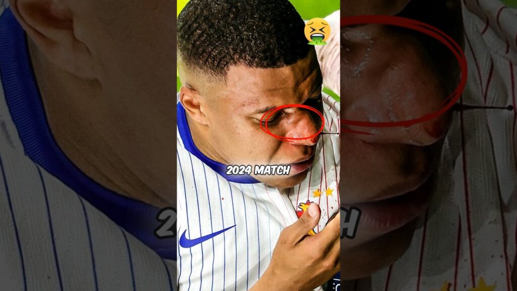 Mbappe's Broke His Nose! #euro2024 #mbappe #soccer