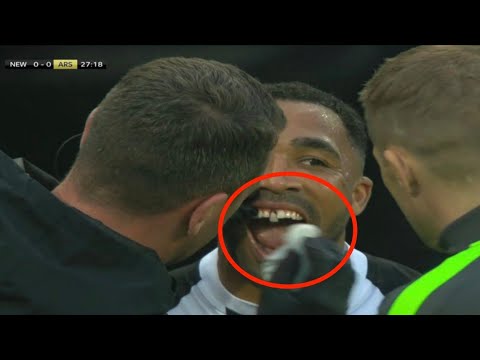 Callum Wilson tooth INJURY Vs Arsenal