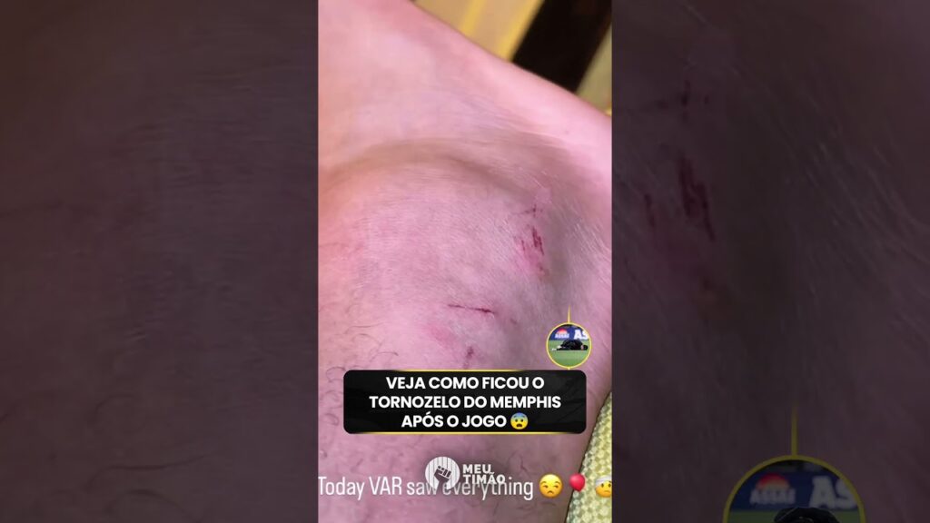 VEJA COMO FICOU O TORNOZELO DO MEMPHIS DEPAY APÓS O JOGO CONTRA O VASCO