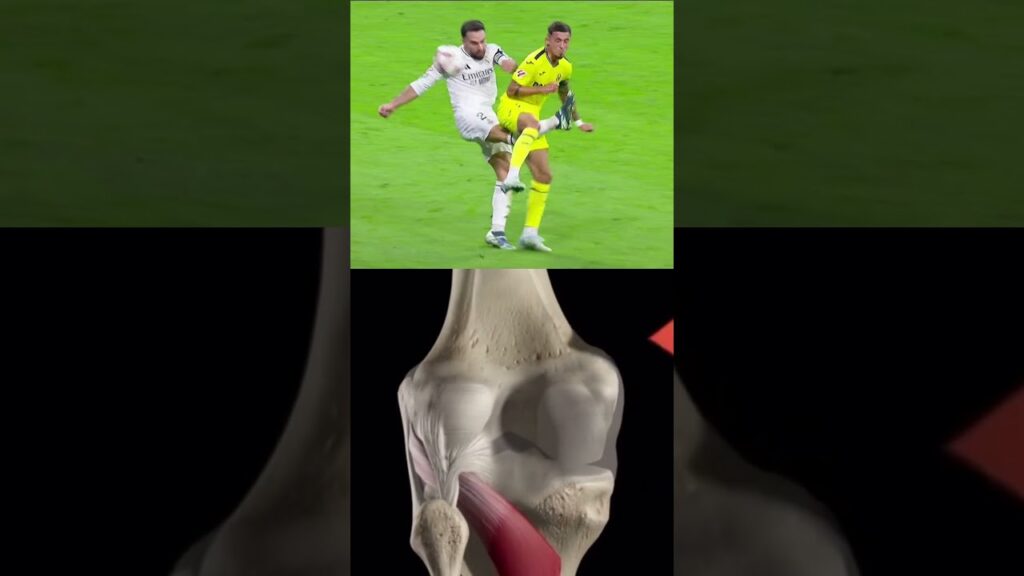 🚨Así fue la lesión que sufrió Dani Carvajal #acl #kneepain #carvajal #realmadrid