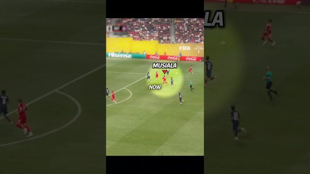 Musiala INJURY Reason? 😢