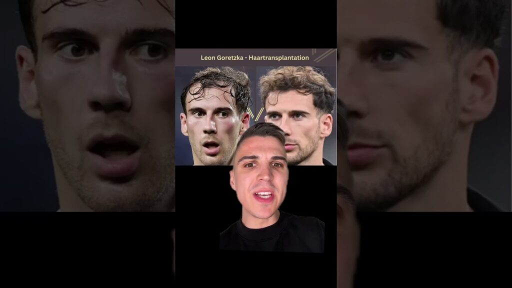 Goretzka Haarausfall