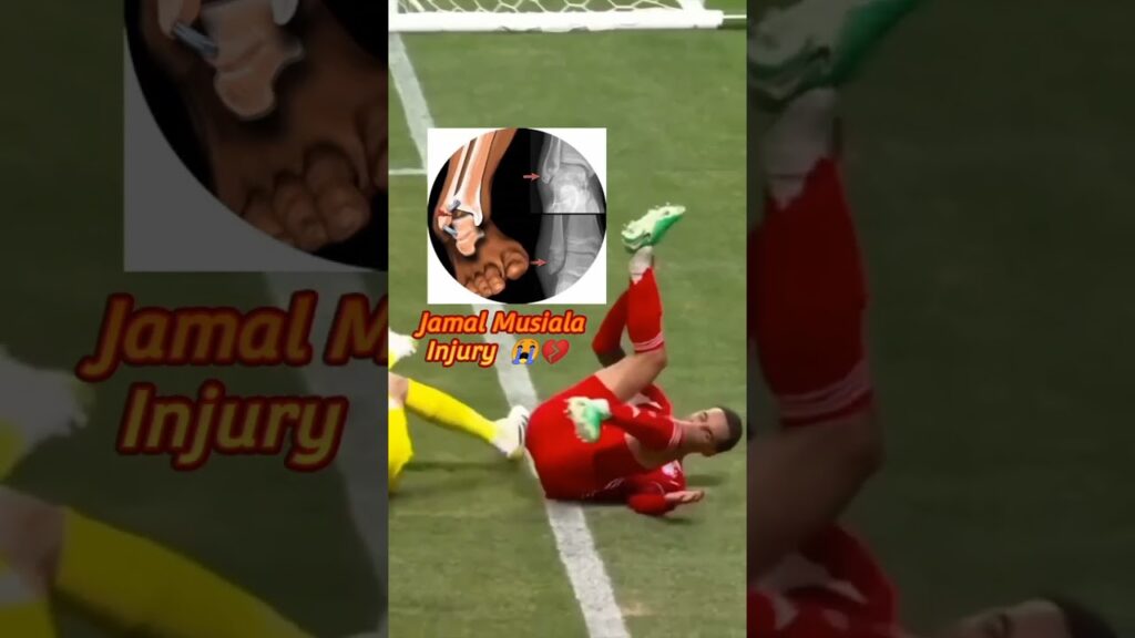 Jamal Musiala Injury 💔😭 | #musiala #jamalmusiala