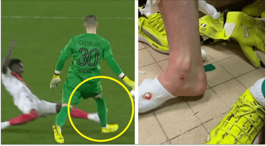 FCK YOU BUTTERFINGERS!!! Why couldnt you just stayed injured. Also, I miss u Gigio. Also, I think that fcking butterfinger piece of Sh!t Chevalier might have spread his cancer to Donnaruma, making him bad. FCK you Chevalier.