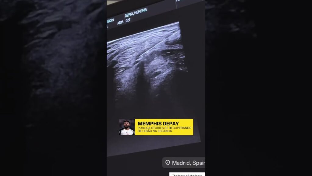 MEMPHIS SE RECUPERA DE LESÃO NA ESPANHA
