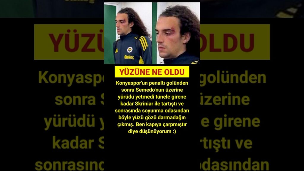 Guendouzi'nin Yüzüne Ne Oldu #football