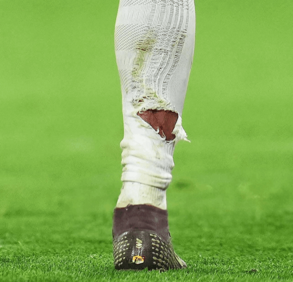 Mbappe's calf after Jonathan Tah's tackle, Tah got a correct yellow on the tackle