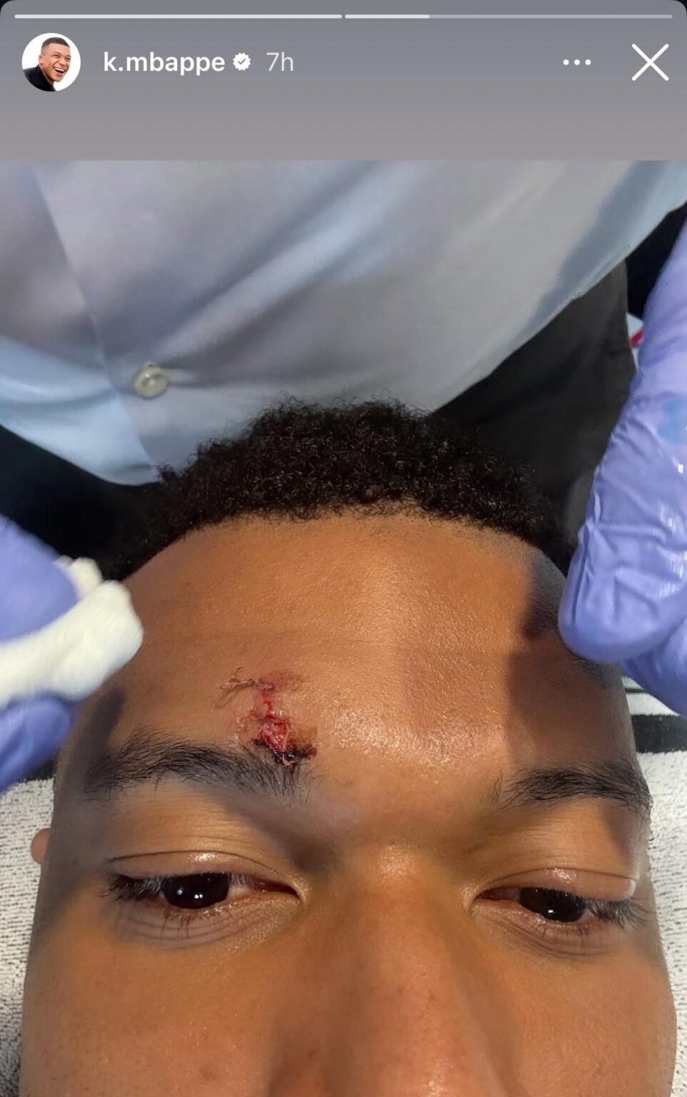Kylian Mbappé's injury from the elbow he received in the opponents box (which went unpunished btw)